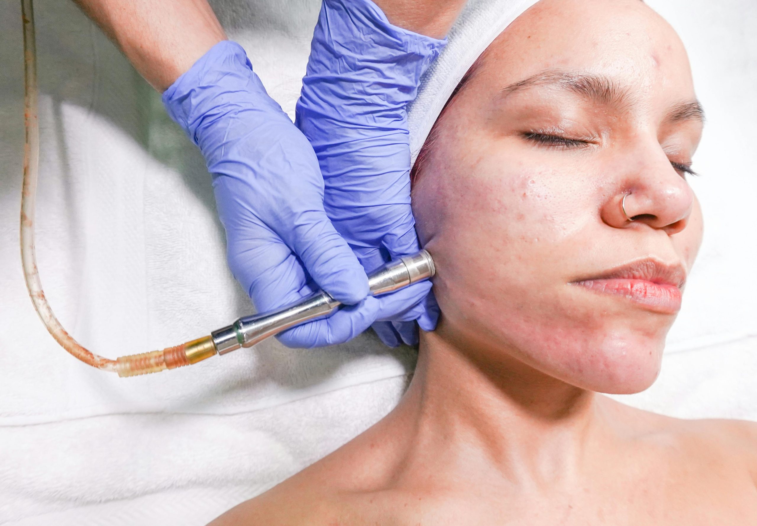 Will One Session of Microdermabrasion Make a Difference?
